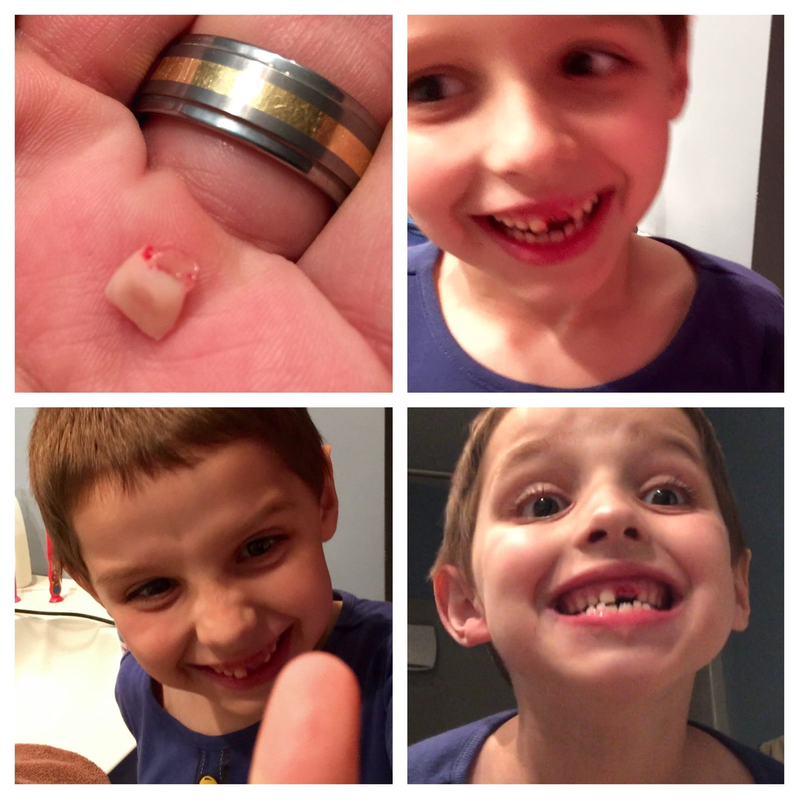 It’s out. Tooth #2. Whew. 